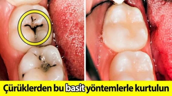 Dikkat Bu Belirtiler Magnezyum Eksikliğine İşaret Ediyor İşte